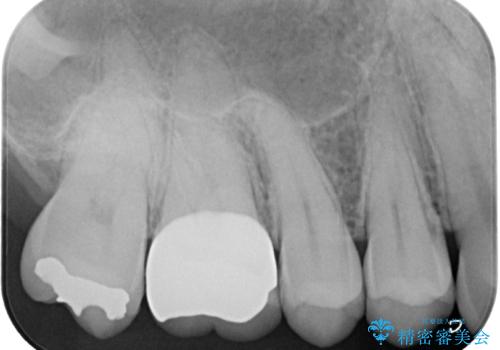 銀歯が外れた。オールセラミッククラウンによる補綴治療の治療後