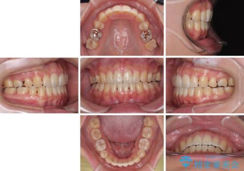 欠損と口元の突出感 ワイヤー装置での抜歯矯正の治療後
