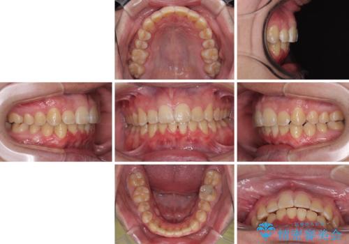 上顎前歯のデコボコを改善してスッキリした口元に ワイヤー装置での非抜歯矯正の治療後