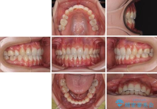 奥歯の咬み合わせのズレと前歯の突出感 変則的な抜歯矯正の治療後