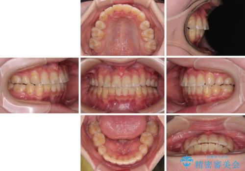 転位歯や埋伏歯などの難易度の高い抜歯矯正治療の治療後