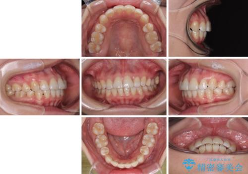 インビザライン・モデレートを用いて気になる後戻りを矯正治療の治療後