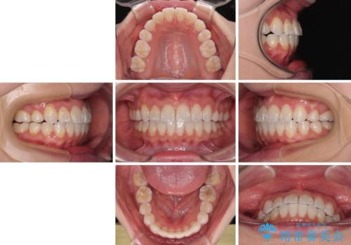 【モニター】八重歯と正中を改善 ワイヤー装置の抜歯矯正の治療後