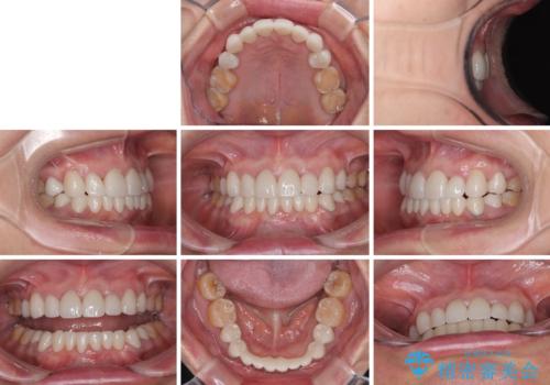 外れるブリッジと気になる八重歯 総合歯科治療で美しい口元にの治療後