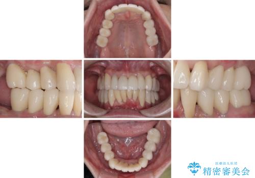 歯周病でグラグラの歯 矯正治療と歯周外科を併用した総合歯科治療の治療後