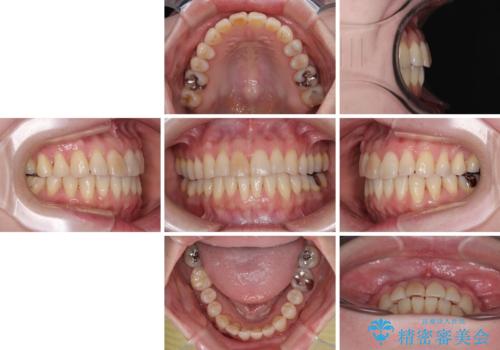 前歯のデコボコをインビザライン・モデレートで矯正治療の治療後