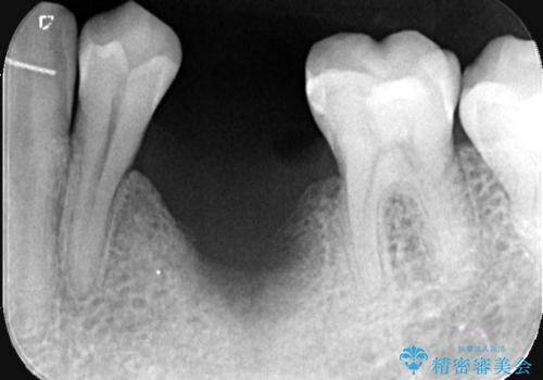 20年前にいれたインプラント|インプラント周囲炎|古いインプラントを除去しインプラント再埋入|痛く無いインプラント治療の治療中