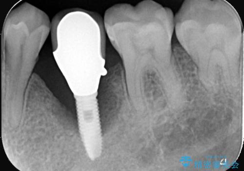 20年前にいれたインプラント|インプラント周囲炎|古いインプラントを除去しインプラント再埋入|痛く無いインプラント治療の治療前