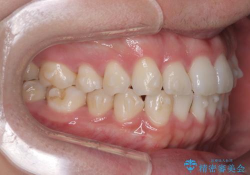 歯のデコボコを治したい|インビザラインで綺麗な歯並びに!|矯正期間は6ヵ月!の治療中