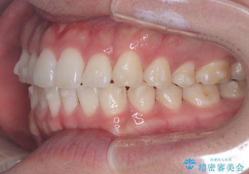 歯のデコボコを治したい|インビザラインで綺麗な歯並びに!|矯正期間は6ヵ月!の治療中