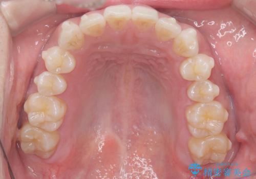 歯のデコボコを治したい|インビザラインで綺麗な歯並びに!|矯正期間は6ヵ月!の治療中