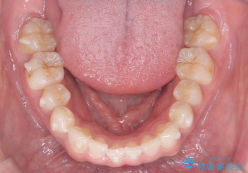 歯のデコボコを治したい|インビザラインで綺麗な歯並びに!|矯正期間は6ヵ月!の治療中