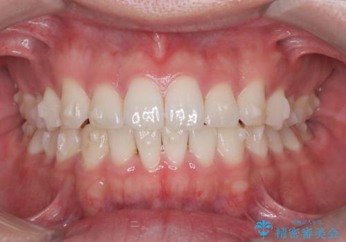 歯のデコボコを治したい|インビザラインで綺麗な歯並びに!|矯正期間は6ヵ月!の治療中