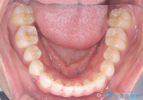 歯のデコボコを治したい|インビザラインで綺麗な歯並びに!|矯正期間は6ヵ月!の治療後
