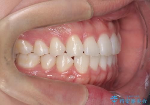 歯のデコボコを治したい|インビザラインで綺麗な歯並びに!|矯正期間は6ヵ月!の治療後