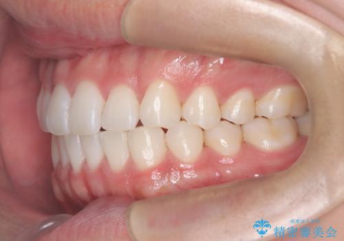 歯のデコボコを治したい|インビザラインで綺麗な歯並びに!|矯正期間は6ヵ月!の治療後