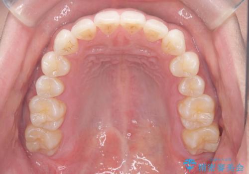 歯のデコボコを治したい|インビザラインで綺麗な歯並びに!|矯正期間は6ヵ月!の治療後
