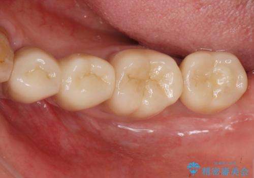 歯周病再生治療と歯周ポケット除去 歯周外科手術の治療後