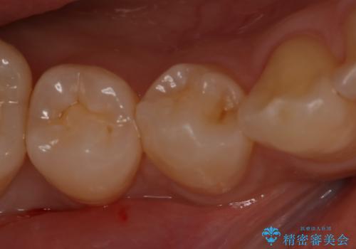 虫歯のところをセラミックで直したい セラミックインレーの治療前