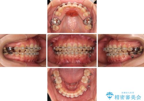 欠損と口元の突出感 ワイヤー装置での抜歯矯正の治療中