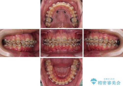 上顎前歯のデコボコを改善してスッキリした口元に ワイヤー装置での非抜歯矯正の治療中