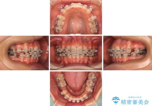 奥歯の咬み合わせのズレと前歯の突出感 変則的な抜歯矯正の治療中