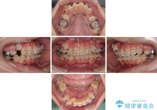 転位歯や埋伏歯などの難易度の高い抜歯矯正治療の治療中