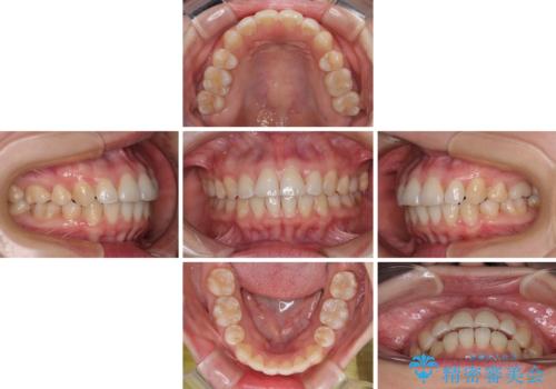 インビザライン・モデレートを用いて気になる後戻りを矯正治療の治療中