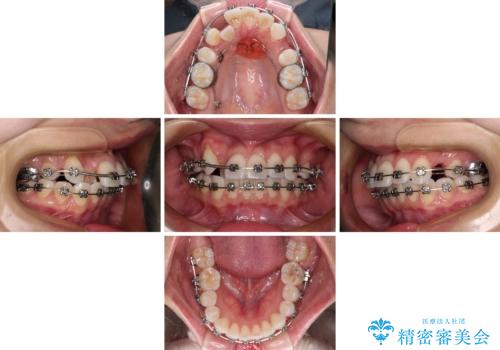 【モニター】八重歯と正中を改善 ワイヤー装置の抜歯矯正の治療中
