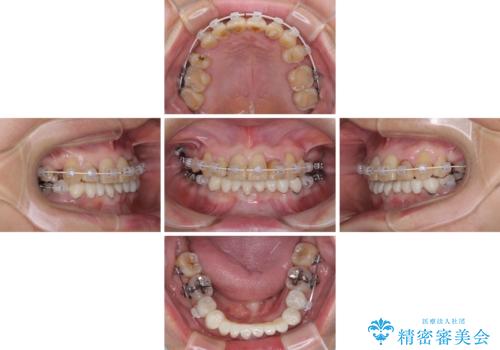 外れるブリッジと気になる八重歯 総合歯科治療で美しい口元にの治療中