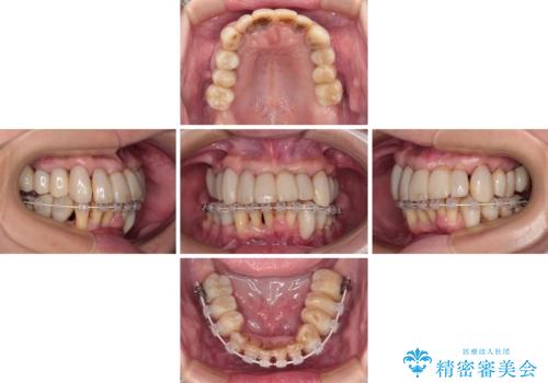 歯周病でグラグラの歯 矯正治療と歯周外科を併用した総合歯科治療の治療中