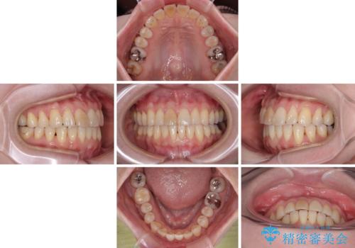 前歯のデコボコをインビザライン・モデレートで矯正治療の治療中