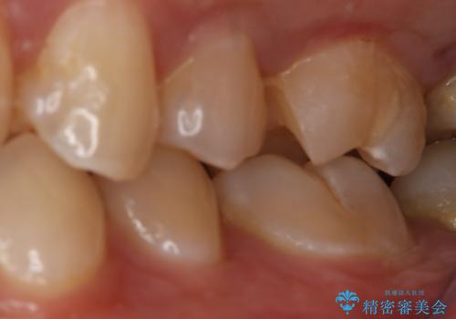 銀歯をやり変えたい セラミックインレーの治療中