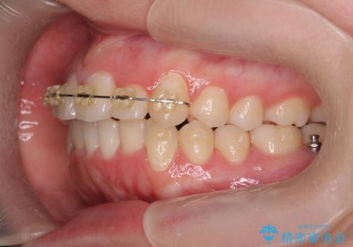 前歯のズレ・がたつき・すれ違いの矯正治療の治療中