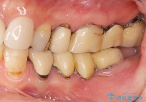 全顎 虫歯 インプラント治療の治療前