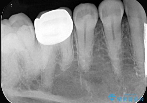 歯が欠けた <セラミッククラウン>の治療後