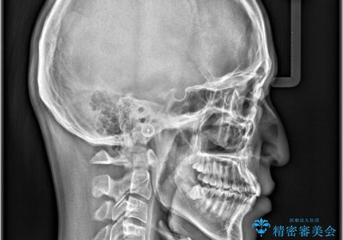 歯のデコボコを治したい|インビザラインで綺麗な歯並びに!|矯正期間は6ヵ月!の治療後