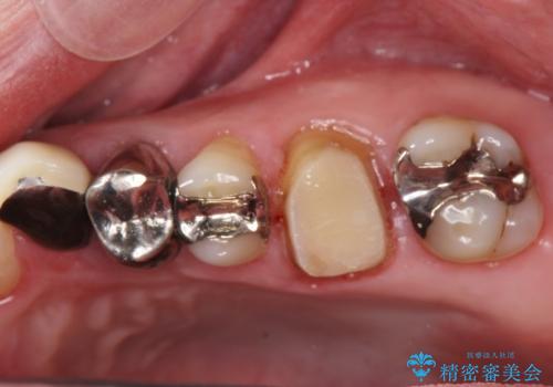 銀歯・虫歯・治療途中の歯を治していきたいの治療前