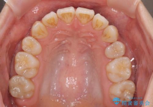八重歯を矯正治療で治したい!の治療後