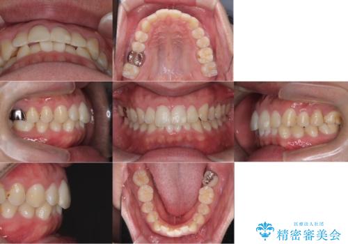 【マウスピース矯正】【インビザライン】前歯の凸凹を治したいの治療前