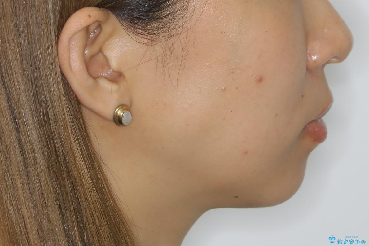 前歯を後ろに下げたい ワイヤー矯正(クリア装置)の治療前(顔貌)