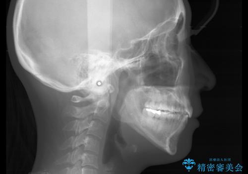 前歯を後ろに下げたい ワイヤー矯正(クリア装置)の治療後