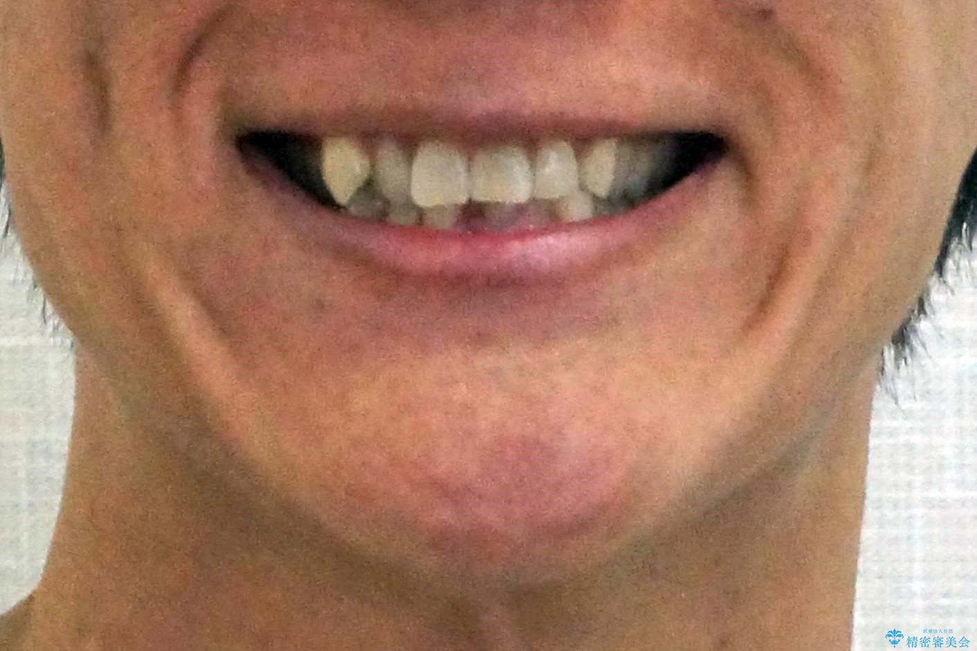 八重歯と下の歯のがたつき マウスピースでの治療前(顔貌)