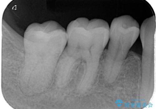 昔の被せ物が取れてしまった セラミックアンレーで治療の治療後