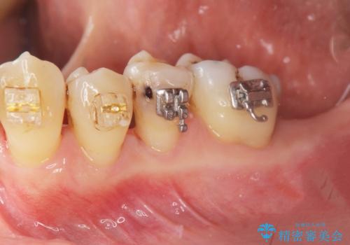 歯周病再生治療と歯周ポケット除去 歯周外科手術の治療前