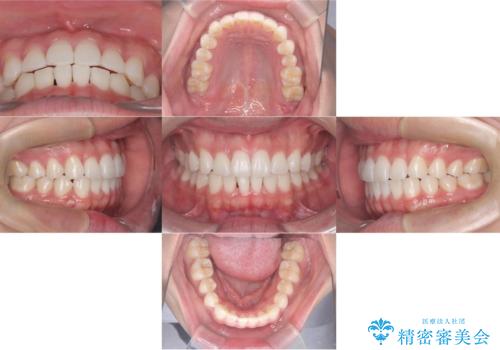 歯のデコボコを治したい|インビザラインで綺麗な歯並びに!|矯正期間は6ヵ月!の治療後