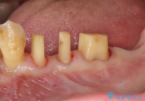 歯周病再生治療と歯周ポケット除去 歯周外科手術の治療中
