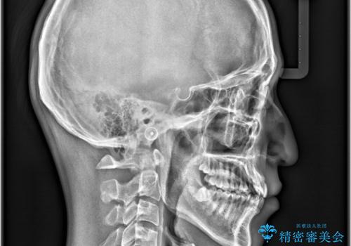 歯のデコボコを治したい|インビザラインで綺麗な歯並びに!|矯正期間は6ヵ月!の治療前