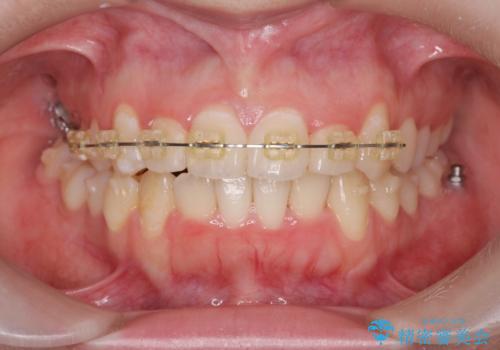 前歯のズレ・がたつき・すれ違いの矯正治療の治療中