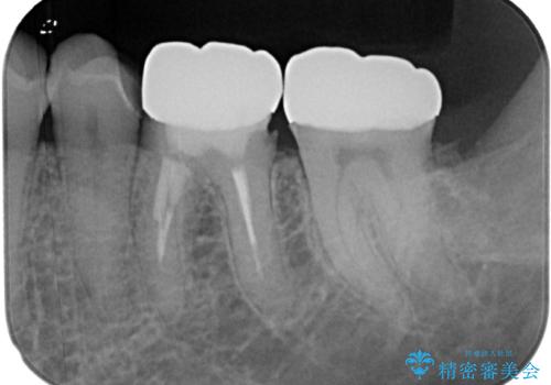 詰め物が欠けた フルジルコニアクラウンの治療後